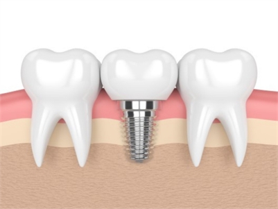 Dental Implants Plantation | Dentist Plantation | Dentist 33323 | Dental Care Of Plantation